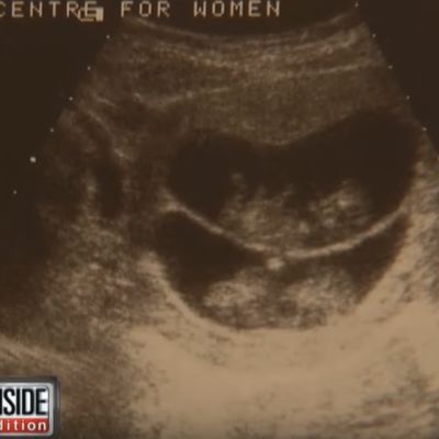 Ultrazvuk bliznakinja izgledao sasvim obično: Zapanjile sve kada su se rodile! (VIDEO)